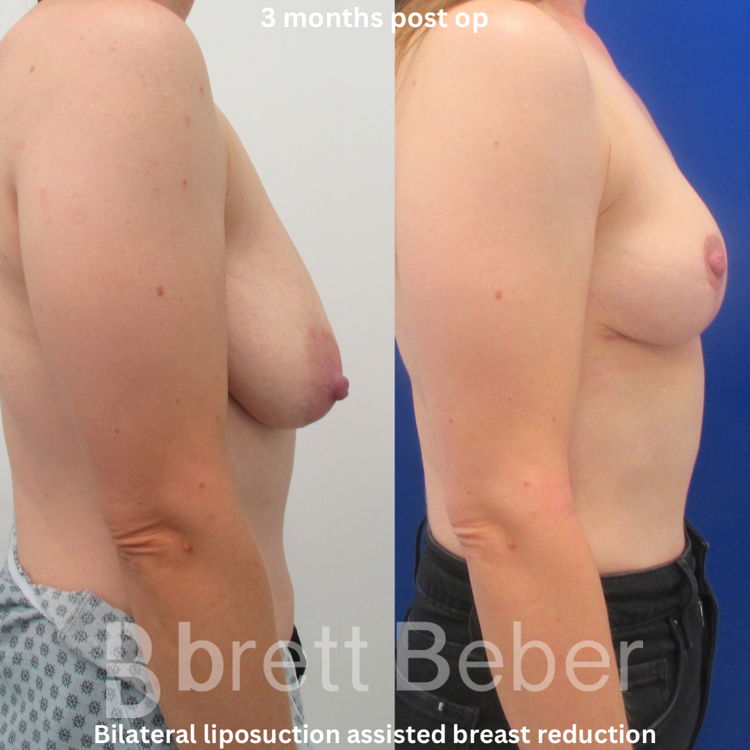 toronto plastic cosmetic surgeon - Breast Reduction