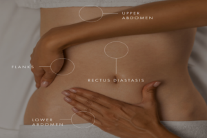 Liposuction vs.Tummy Tuck in Toronto