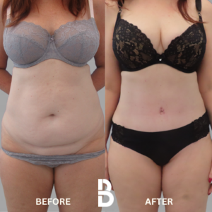 Tummy Tuck