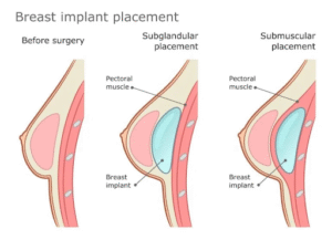 Breast Lift vs. Breast Implants