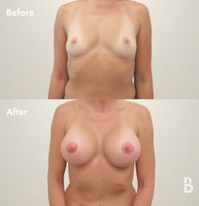 Breast Augmentation in Toronto